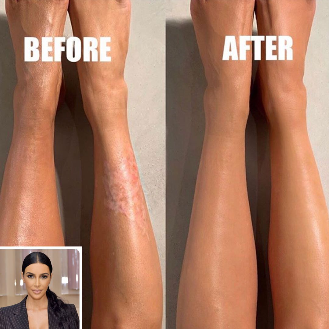 Kim Kardashian Covers Up Her Psoriasis Using New Kkw Beauty Body Makeup