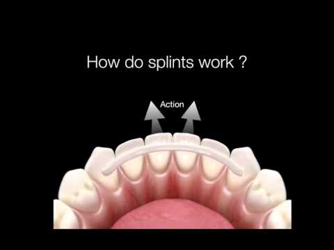 How Do Dental Splints Work