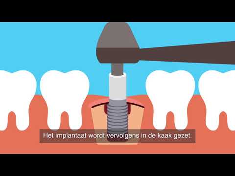 Een implantaat zetten bij de tandarts