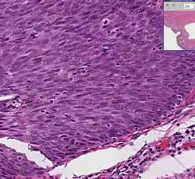 Histopathology Cervix --Squamous metaplasia & carcinoma-in-s