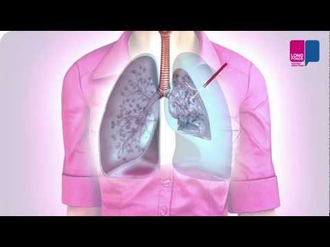 Klaplong - wat gebeurt er in je longen?