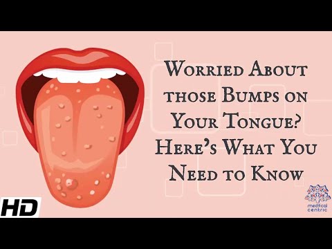 Worried About Those Bumps on Your Tongue? Here's What You Need To Know